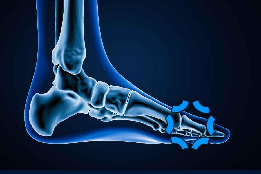 Morton's Neuroma depiction