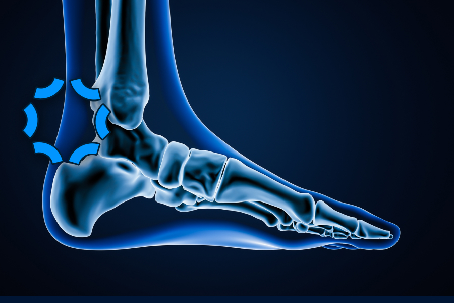 Achilles Tendonitis depiction