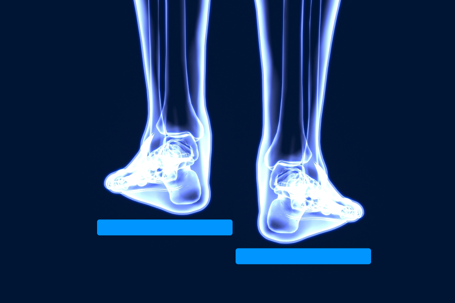Leg Length Discrepancy X-ray