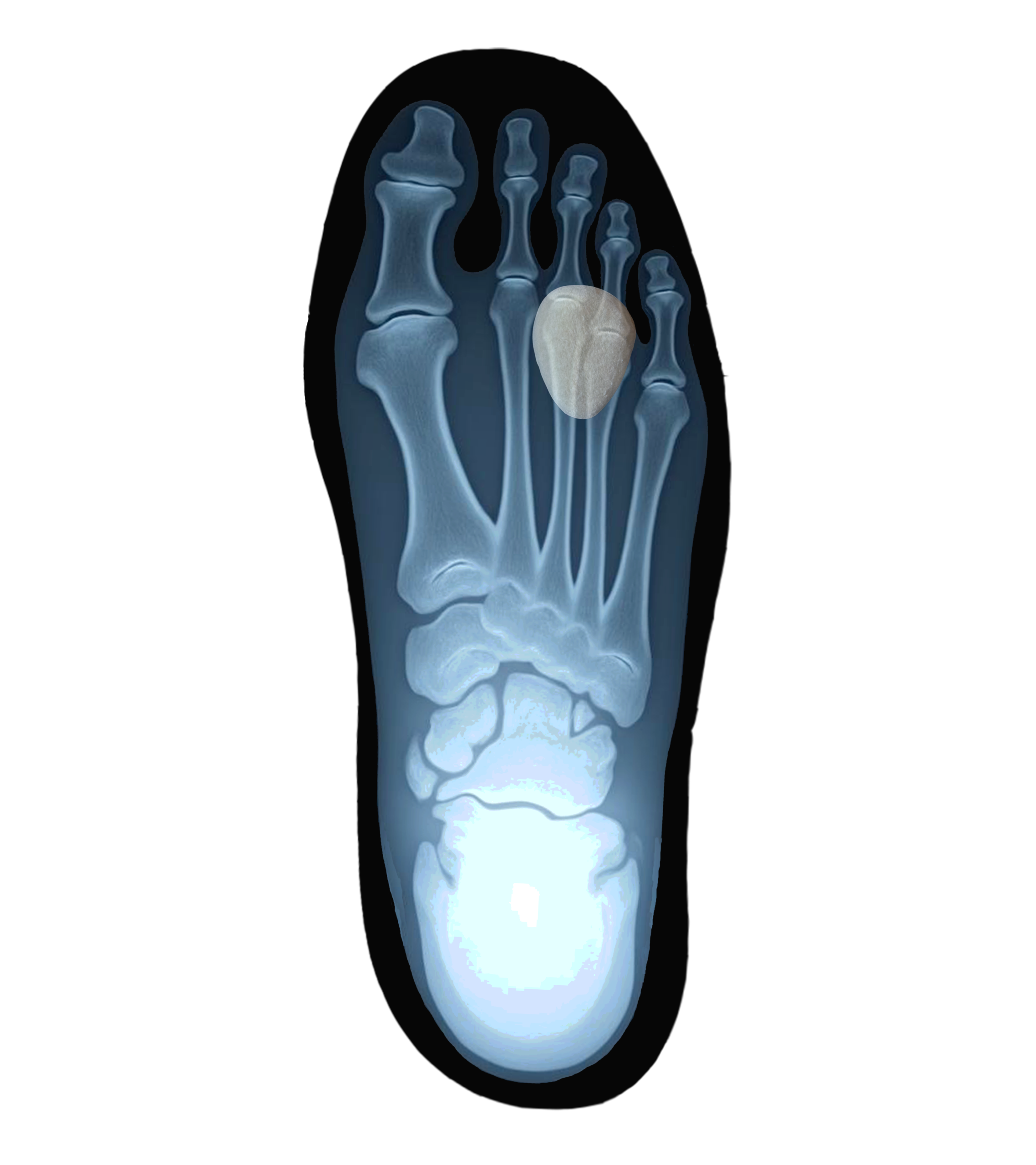 Neuroma Pads - Image 2